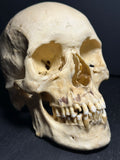 Human Skull with Linear Enamel Hypoplasia (LEH)
