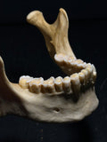 Human Skull with Linear Enamel Hypoplasia (LEH)